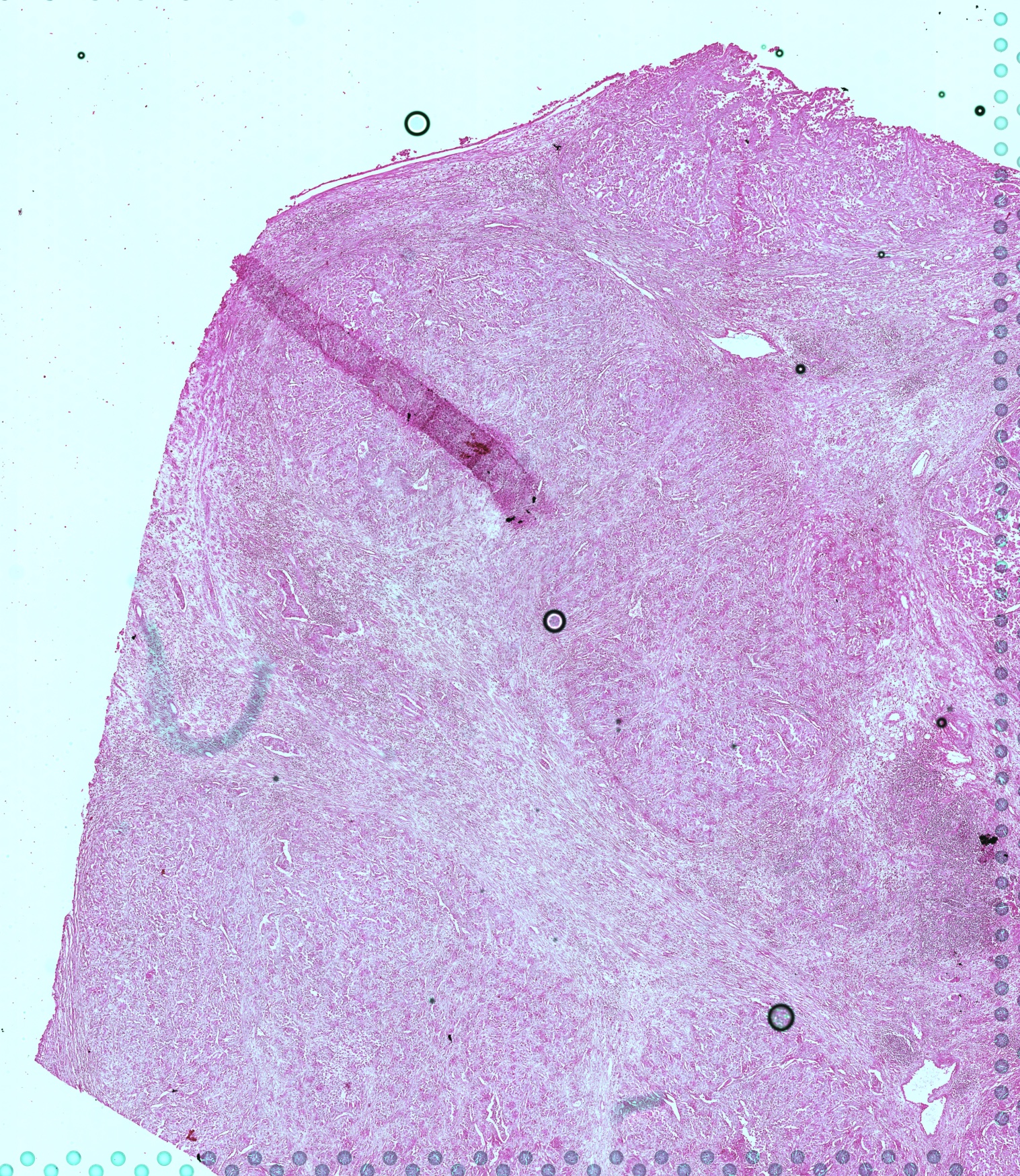 Renal cell carcinoma tissue section used in the HistAgent TLS case study